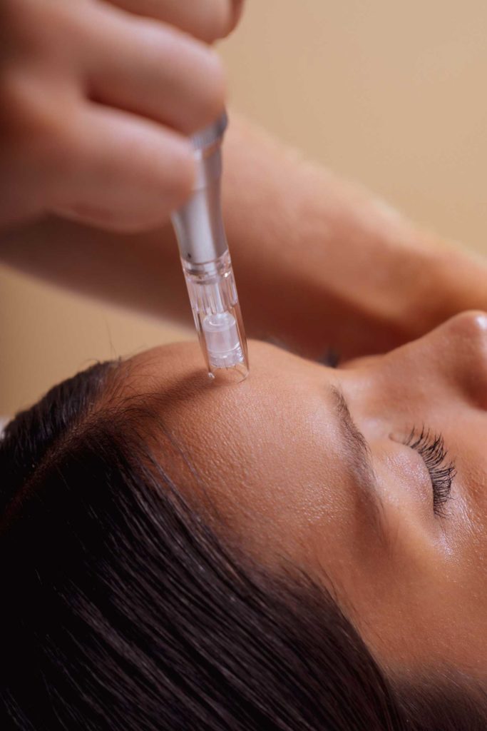 Micro-Needling: Truths and Myths | SKN Skin Clinic Vancouver