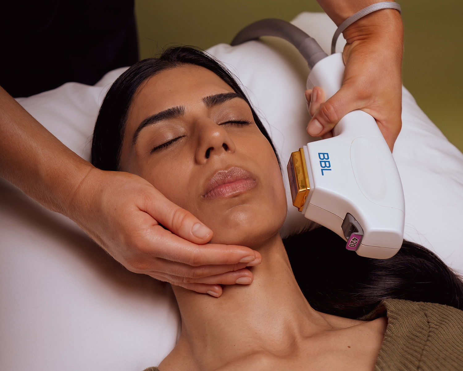 Treating Acne with Forever Clear BBL | SKN Skin Clinic Vancouver