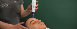 Microneedling