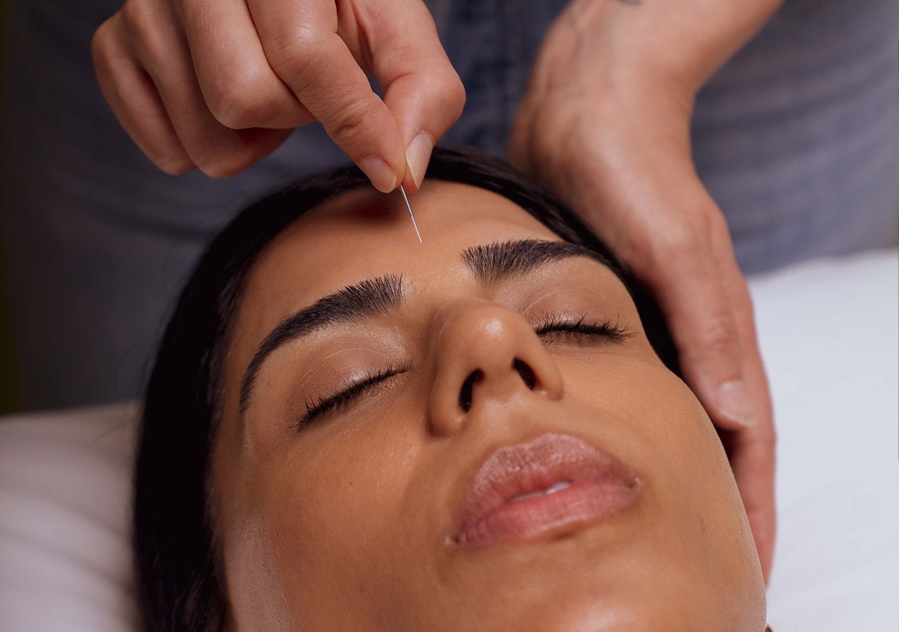 Micro-Needling Treatment